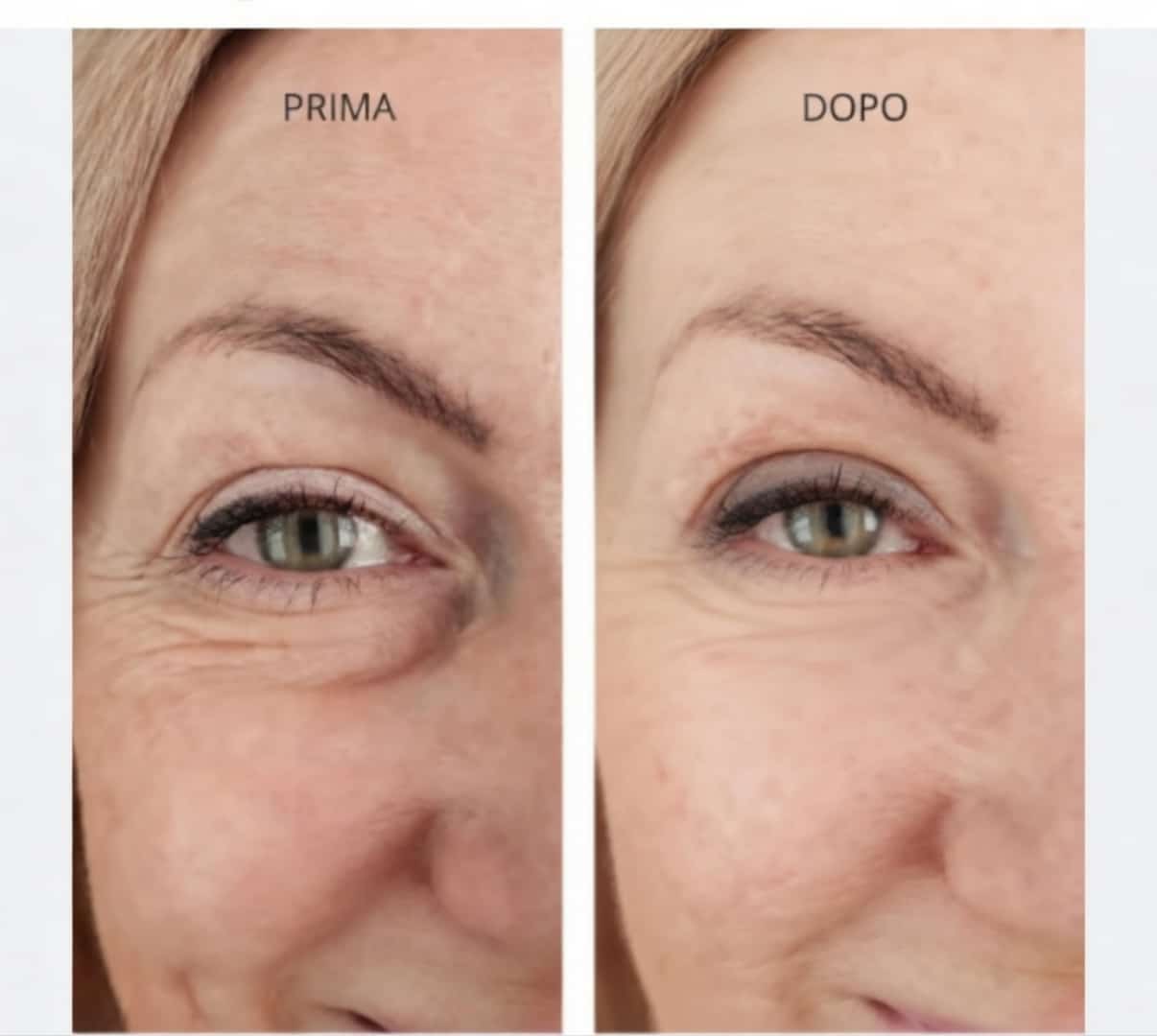 Esosomi Siero rigenerazione pelle